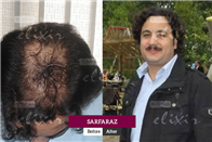 Restore Your Lost Hair Naturally at Elixir Hair Transplant Center Islamabad