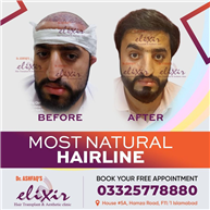 Permanent Hair Transplant at Elixir Hair Transplant Center Islalabad
