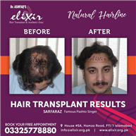 Hair Transplant Before And After Best Result at Elixir Clinic