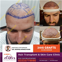 Permanent Hair Transplant at Elixir Hair Transplant Center Islalabad
