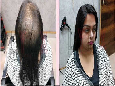 Best Hair Wigs Services in Delhi @/hair-wigs- delhi/